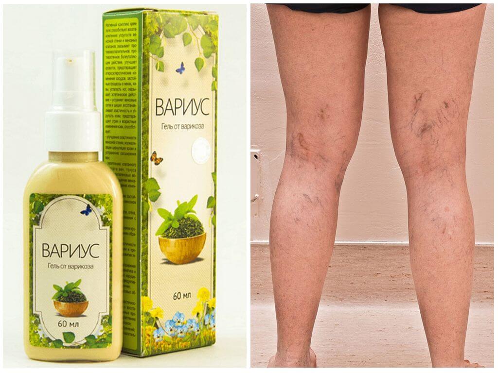 Средство от варикоза Вариус