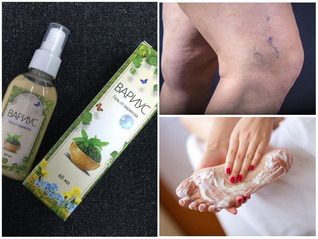 Применение геля Вариус при варикозном расширении вен