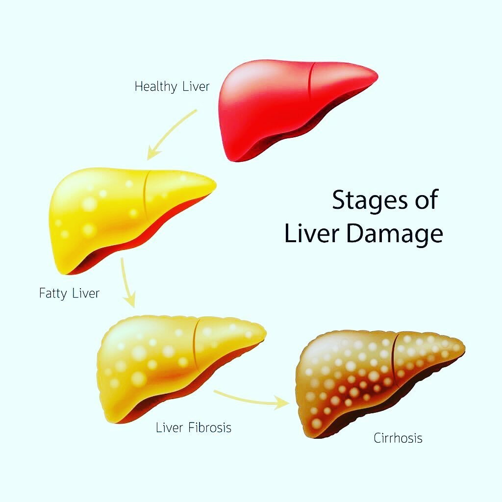Стадии алкогольной болезни печени