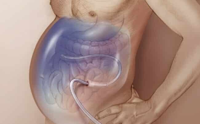 Асцит при циррозе