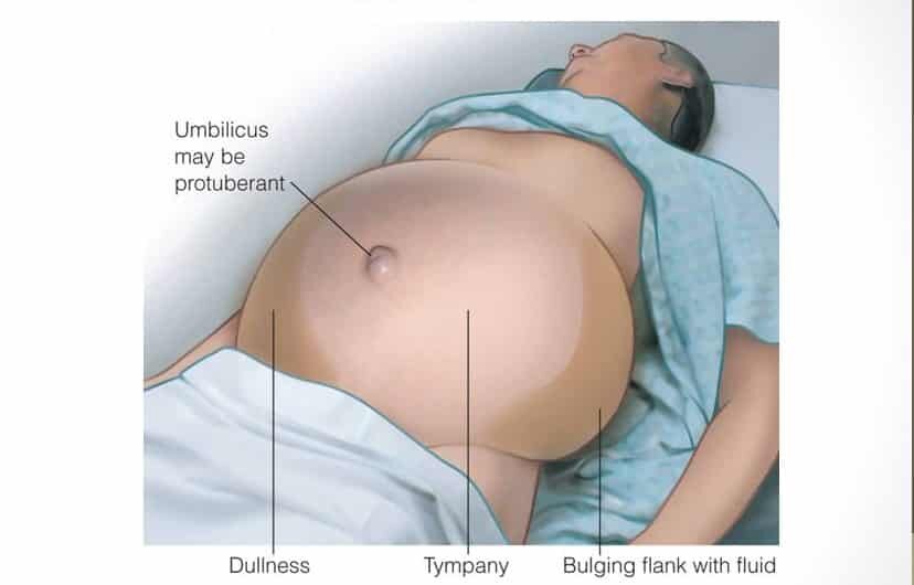 При напряженном асците выпячивается пупок