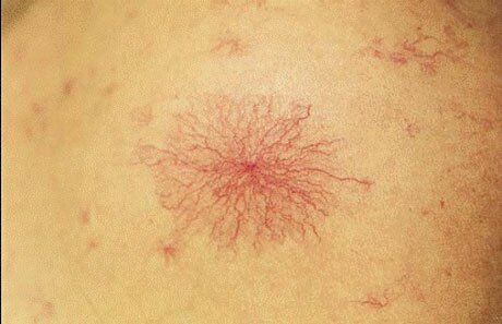 Сосудистые звездочки при циррозе