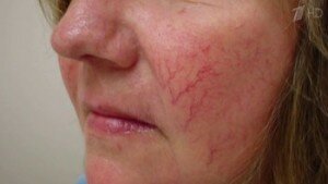 Сосудистые звездочки на лице