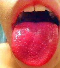 Фото языка при циррозе