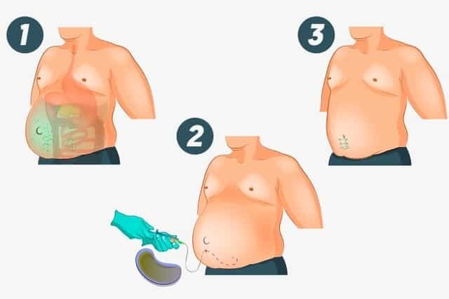 Выполнение лапароцентеза