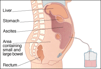Лапароцентез при асците