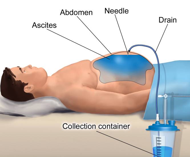 Парацентез при асците