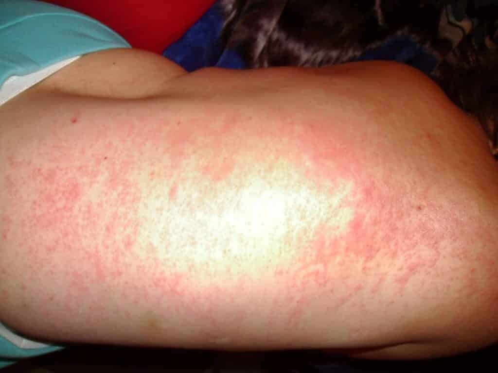 Сыпь при гепатите А