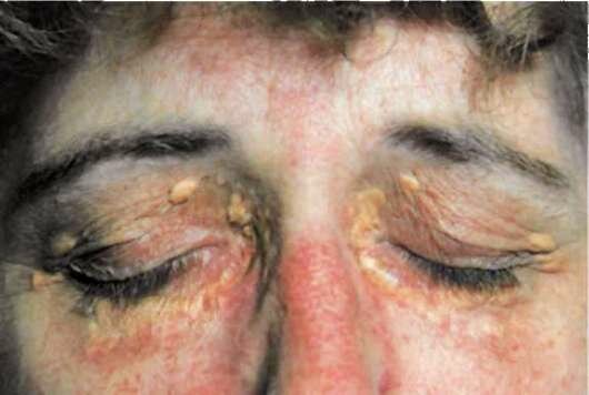 Ксантомы про циррозе