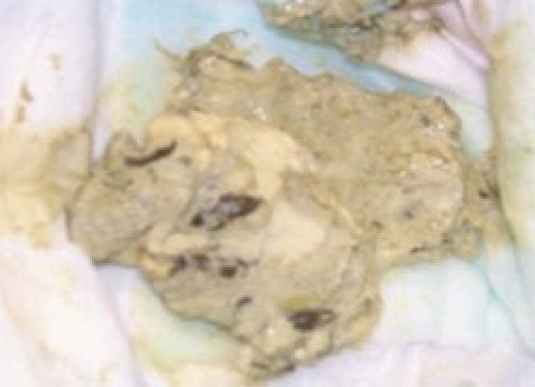 Фото белого кала прициррозе