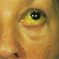 Фото склер при циррозе