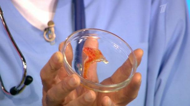 ржавая мокрота фото Ржавая мокрота — при каких заболеваниях?