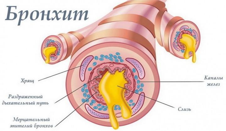 Бронхит: схема просвета бронха в разрезе