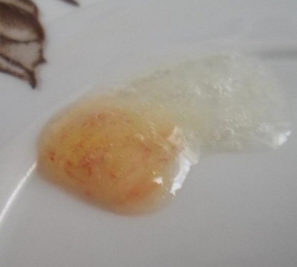 прозрачная мокрота с кровью