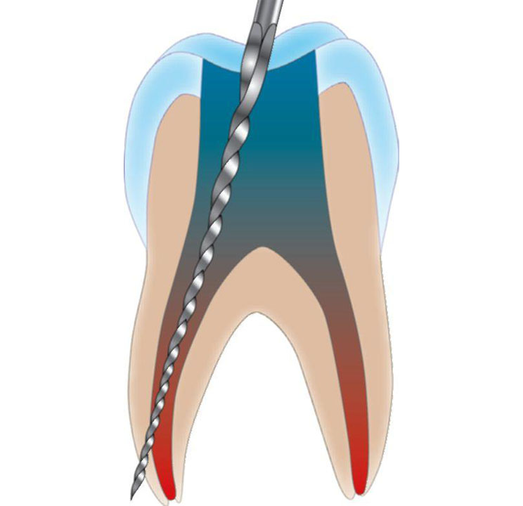 Перфорация стенки зуба