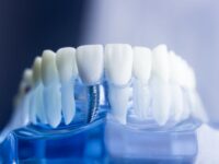 Зуб за зуб – одномоментная имплантация